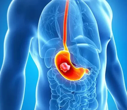 როგორ ვლინდება გასტრიტი? – სიმპტომები, მკურნალობა და პრევენციის გზები gastriti, simptomebi da mkurnaloba